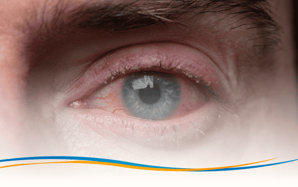Blepharitis