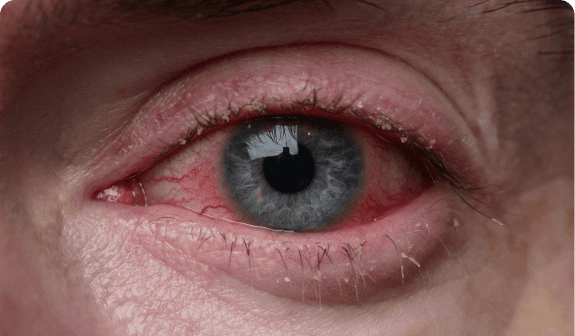 Blepharitis