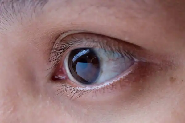 Asian woman eye checkup for glaucoma