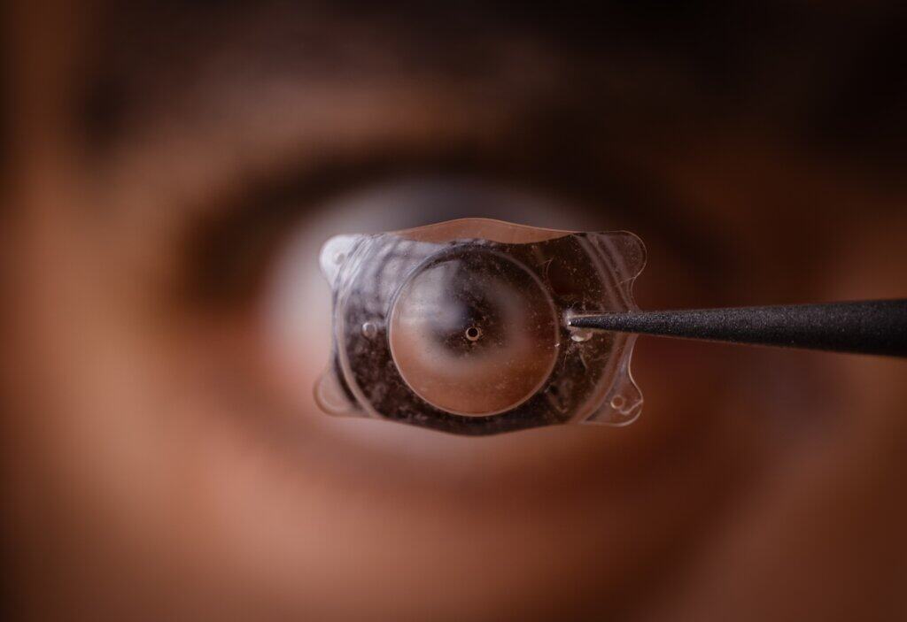 implantable collamer lens