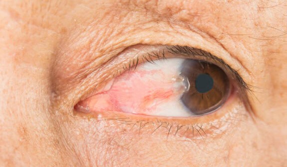 Pterygium